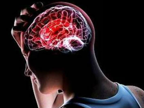 Migraines