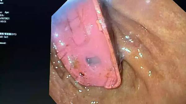 எக்ஸ்-ரே மற்றும் எண்டோஸ்கோபி படங்கள்