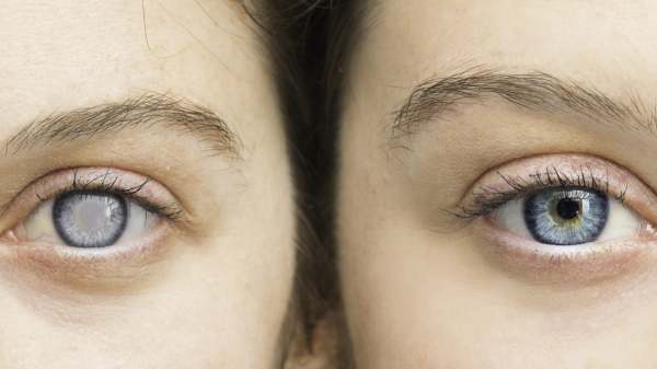 8. கண்புரை அறுவை சிகிச்சை மற்றும் ஒப்பனை அறுவை சிகிச்சை