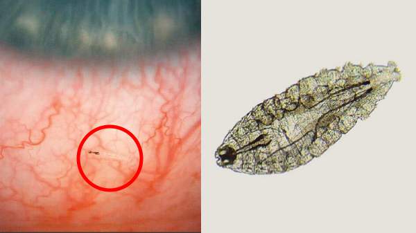 மனிதனின் கண்களுக்குள் நெளிந்த மைக்ரோ சைஸ் புழுக்கள்.. அலட்சியத்தால் ஏற்பட்ட விபரீதம்.. இறுதியில் என்னானது?